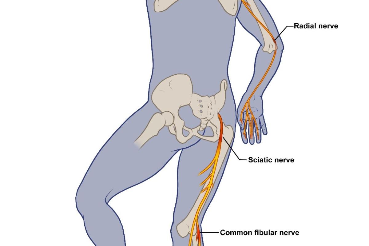 COVID19 Nerve Damage Study led by Shirley Ryan AbilityLab